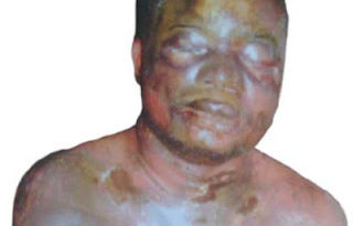 Jealous woman bathes lover with acid in Calabar 9
