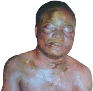 Jealous woman bathes lover with acid in Calabar 1