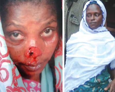 Woman Bites Off Neighbour’s Nose 9