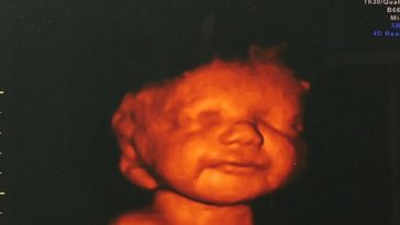 PHOTO: See the 3D scan of an unborn disabled baby’s smile 1
