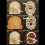 Pencil Stuck In 19 Month Old Baby's Brain, Pierces Her Eye 2