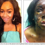 20-Year Old Nigerian Girl Attacked With Acid in London 9