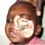 Have You Heard About This Shocking Face Eating (Noma) Disease Spreading Around Nigeria 2