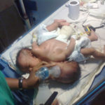 Pictures Of Co-Joined Twins Delivered At UNTH Enugu 4