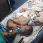 Pictures Of Co-Joined Twins Delivered At UNTH Enugu 2