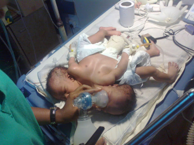 Pictures Of Co-Joined Twins Delivered At UNTH Enugu 1
