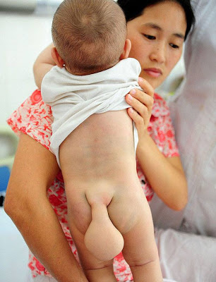 PHOTOS: Mum To Baby Born With Tail Begs Doctors To Save His Life 2