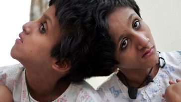 'Let my little girls die,' pleads father of 15-year-old conjoined twins suffering from blinding headaches 1