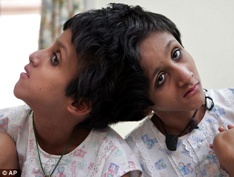 'Let my little girls die,' pleads father of 15-year-old conjoined twins suffering from blinding headaches 8