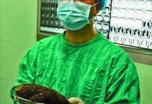Photo : Doctors remove half-kilo hair from a 12-year-old girl's stomach 11