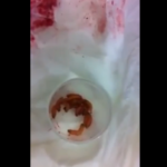 For Those Of You Who Have Unprotected Sex, Watch This Video Of Doctors Removing Live Maggots From A Woman's Vagina 2