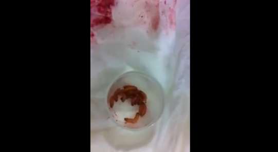 For Those Of You Who Have Unprotected Sex, Watch This Video Of Doctors Removing Live Maggots From A Woman's Vagina 1