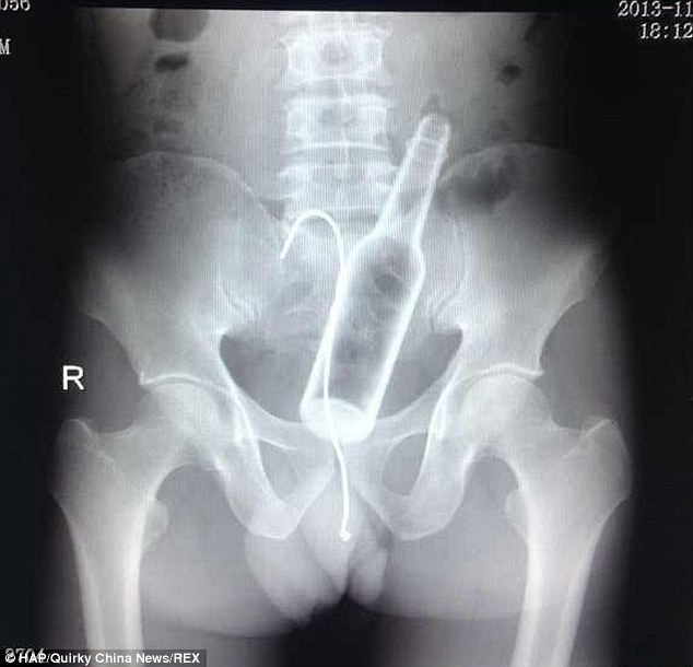 X-rays Shows Bottle Stuck In Man's Butt... And The Hooked Wire He Tried To Pull It Out With That Got Trapped As Well 13
