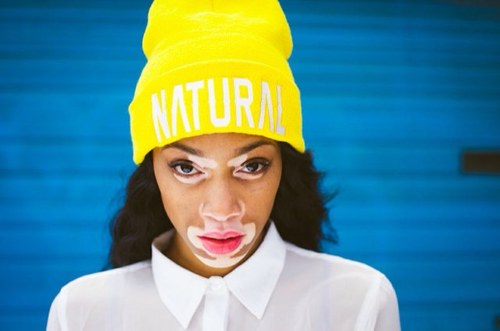Hottie Of The Day - See The Girl With Vitiligo Disease And She Models 2