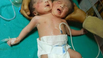 PHOTOS: Indian Woman gives birth to Conjoined Twins 2