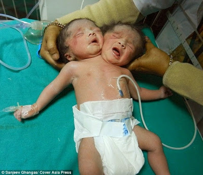 PHOTOS: Indian Woman gives birth to Conjoined Twins 1