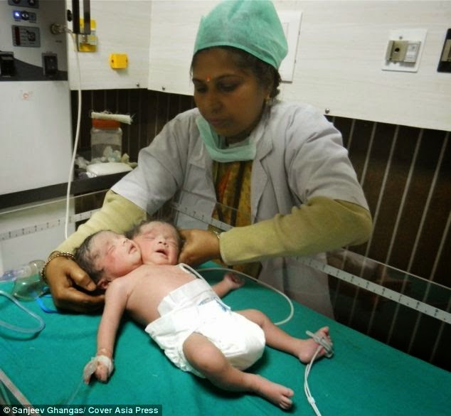 PHOTOS: Indian Woman gives birth to Conjoined Twins 2