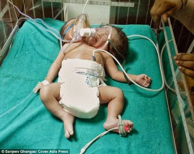 PHOTOS: Indian Woman gives birth to Conjoined Twins 3