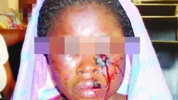 Husband Beats Up, Stabs Wife Close To Her Eyes Because She Didn't Open The Gate For Him 4