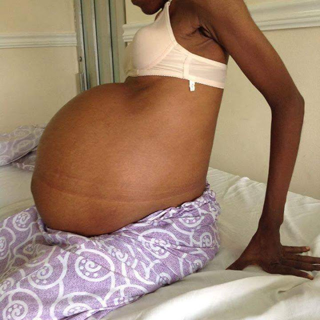 Nigerian Doctors Remove Thr World's Largest Fibroid From A Woman's Belly, Breaks Guinness Book Of Records 2