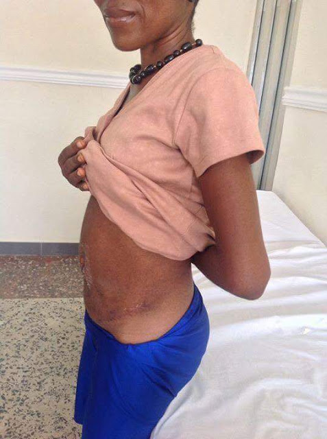 Nigerian Doctors Remove Thr World's Largest Fibroid From A Woman's Belly, Breaks Guinness Book Of Records 3