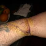 Doctors Find Chop Stick Embedded In Man’s Hand One Month After Using It To Open Beer Bottle While Drunk 14