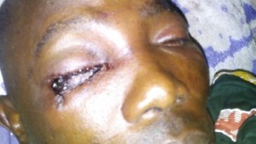 FRSC Official Whose Eye was Plucked Out By Soldiers Begs for Justice [PHOTOS + VIDEO] 8