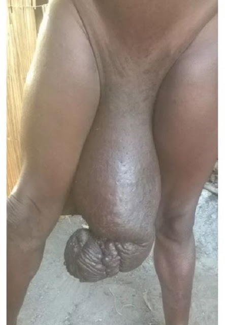 UNBELIEVABLE: This Man is Suffering From A Health Condition That Has Made His Penis Become Massive 5