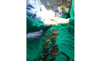 UNBELIEVABLE: Doctors Remove 40 Knives From Man’s Stomach In India [PHOTO] 5