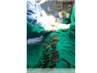 UNBELIEVABLE: Doctors Remove 40 Knives From Man’s Stomach In India [PHOTO] 1