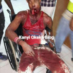 Nigerian man left with badly damaged jaw after phone explodes while charging and making calls. [PHOTO] 11