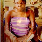 20-year-old Epileptic Lady in Terrible Condition After Falling Into a Fire (Photo) 18