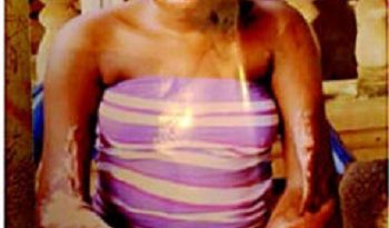 20-year-old Epileptic Lady in Terrible Condition After Falling Into a Fire (Photo) 3