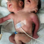 Baby born with two heads die after doctors decide it was too difficult to operate on him [PHOTOS] 4