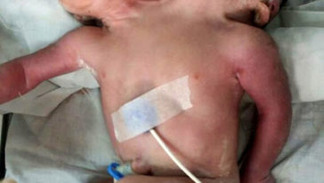 Baby born with two heads die after doctors decide it was too difficult to operate on him [PHOTOS] 2