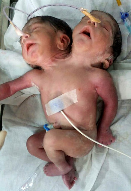 Baby born with two heads die after doctors decide it was too difficult to operate on him [PHOTOS] 1