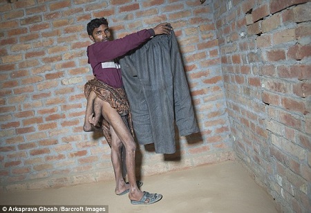 Meet the Young Man Who was Born with 4 Legs (Photos) 4