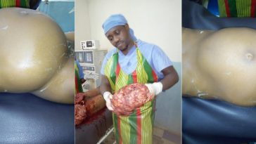 See What Doctor Removed From A Woman Who Appeared Pregnant [Graphic Photos] 12