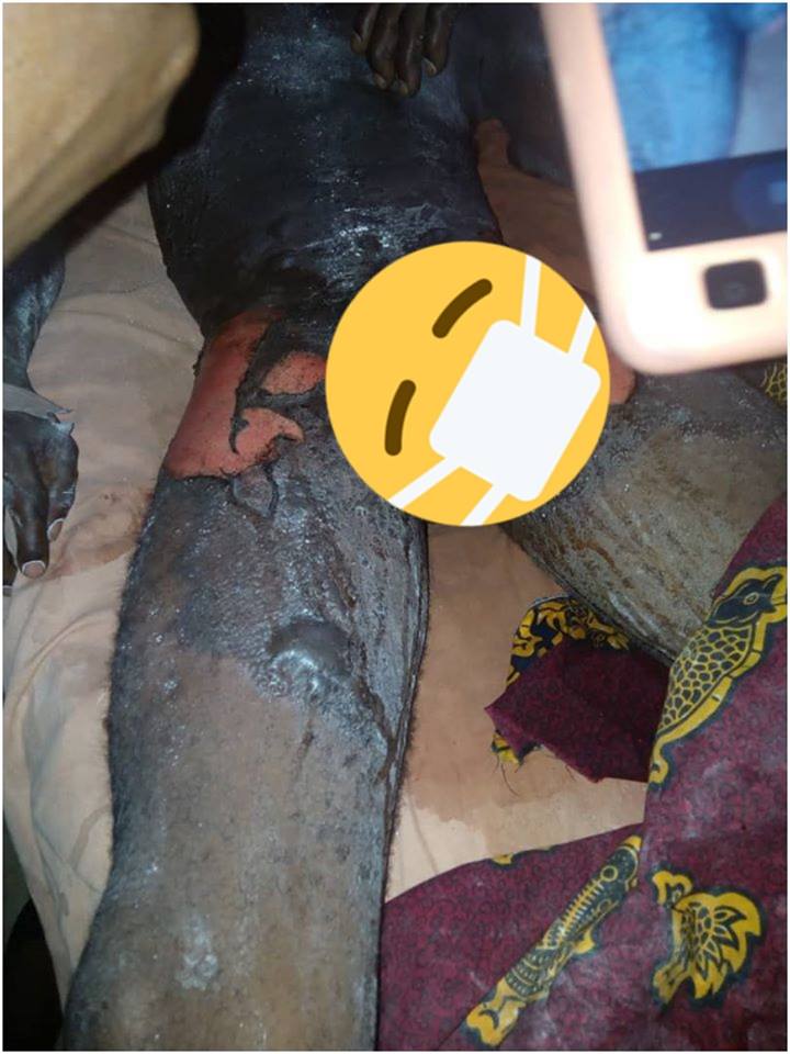 Woman Pours Hot Water Mixed With Pepper On Her Husband In Delta State [Graphic Photos] 5