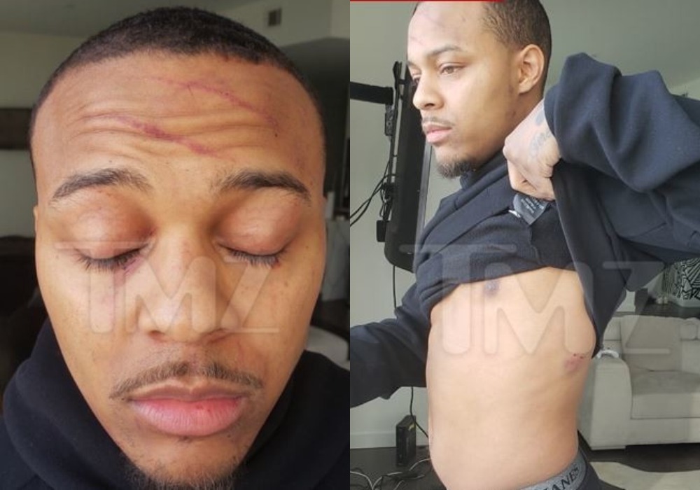 Bow Wow Shares Photos Of Injury Sustained From Fight With Girlfriend 2